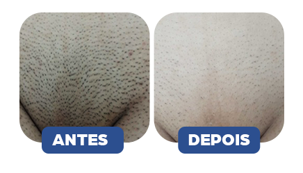 Antes e depois - Resultado 1