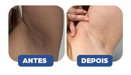 Antes e depois - Resultado 3